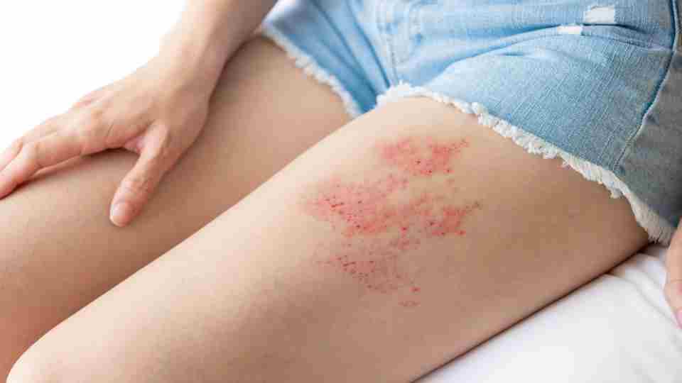 Shingles: Causes, Symptoms and Treatments
